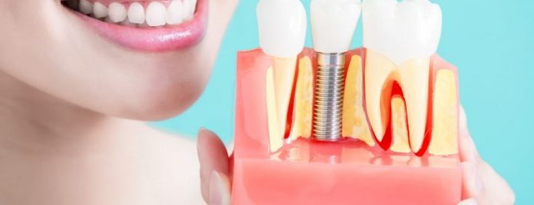 Definirea-termenilor-cheie-pentru-implantul-dentar
